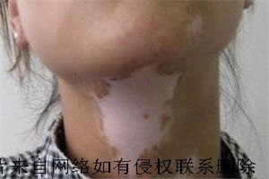  白癜风患者爱养宠物可以吗