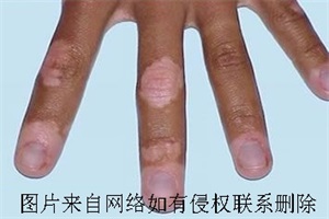  手指白癜风康复会有哪些症状