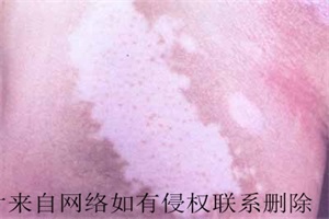  白癜风患者对于高压要远离
