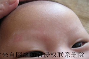 白癜风患者在病情好转期注意什么