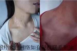 对于饮食禁忌白癜风患者需注意