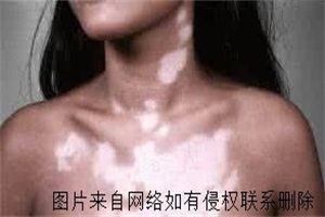  女性病发白癜风什么因素导致