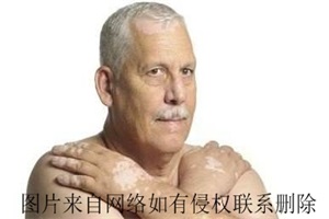  老年人白癜风秋冬季怎么预防