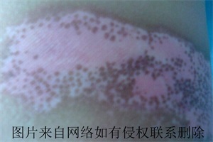  男性白癜风治疗该去怎么做有效